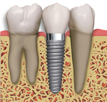 San Jose Bay Area Single Tooth Implant